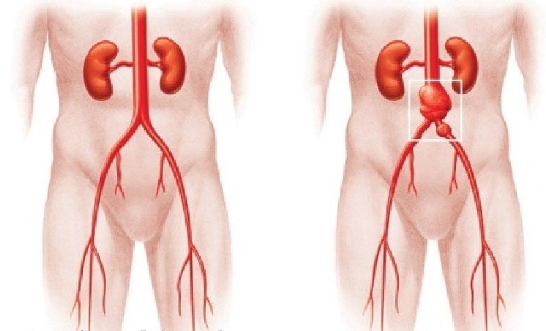 Ανεύρυσμα Κοιλιακής Αορτής