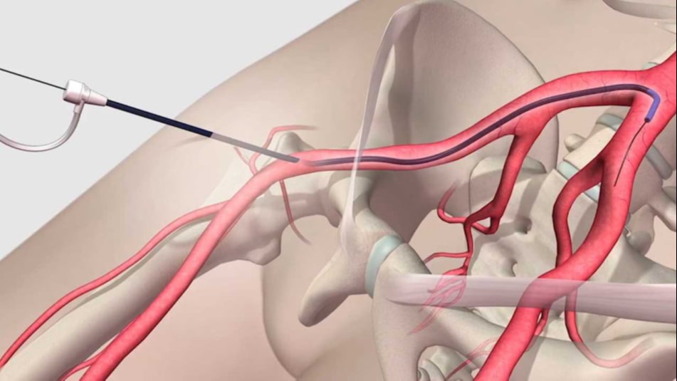 Ανεύρυσμα μηριαίας Αρτηρίας