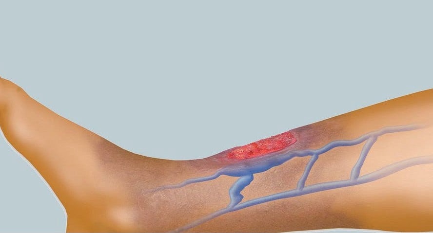Άτονα φλεβικά Έλκη