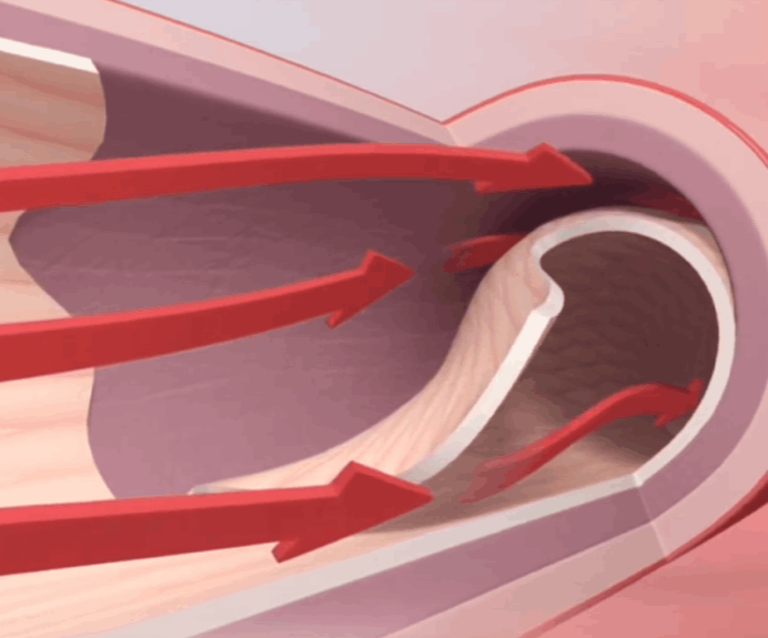 Διαχωρισμός Αρτηριών