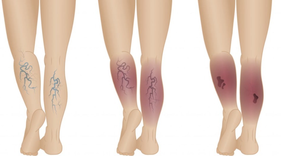 Φλεβικά Έλκη