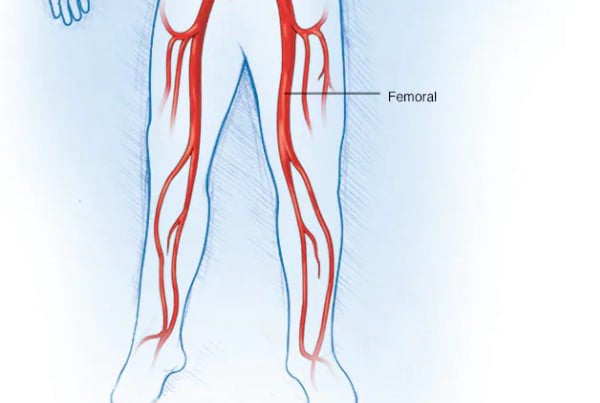 Αρτηριακές παθήσεις κάτω άκρου