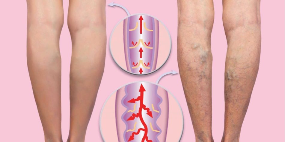 Κιρσοί κάτω άκρων (Επιπολής Φλεβική Ανεπάρκεια)