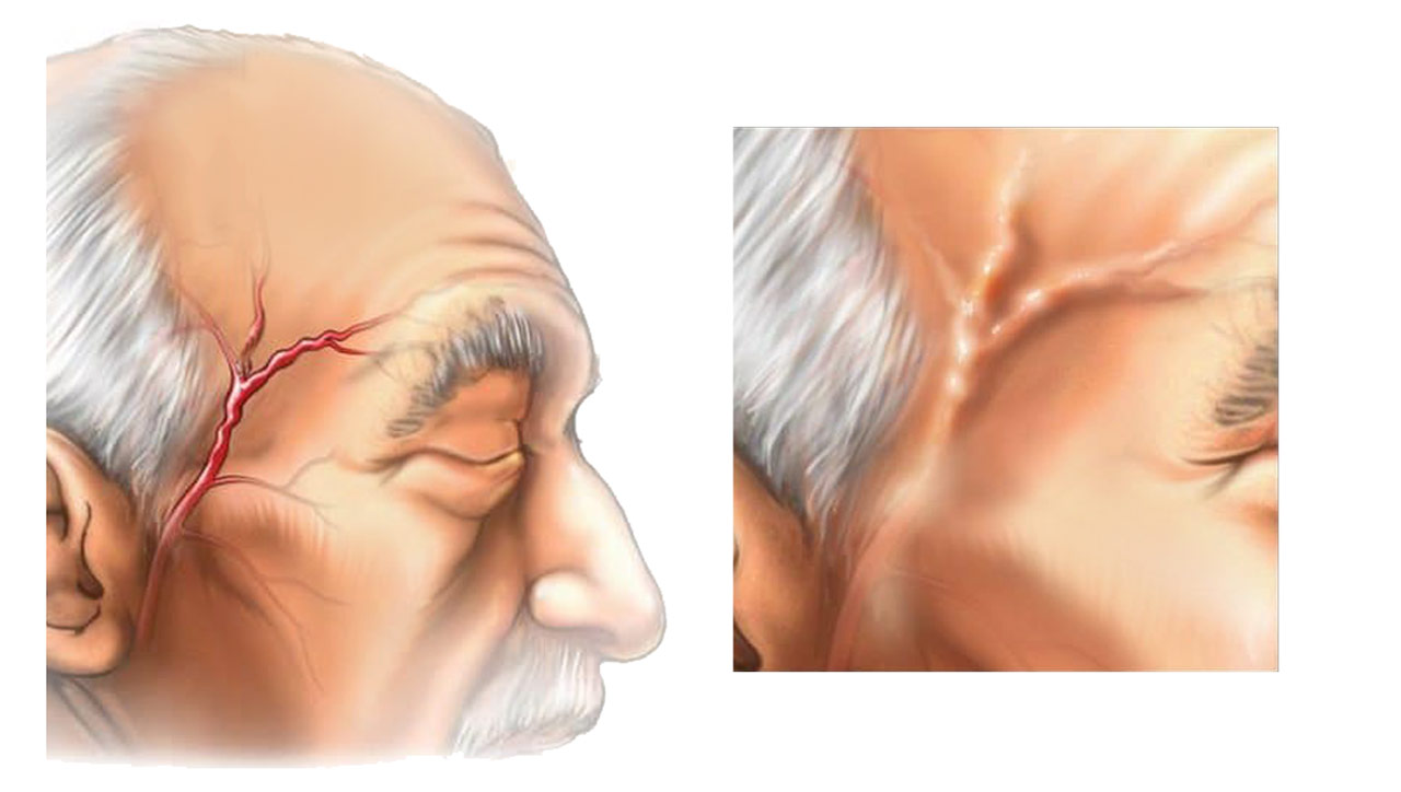 Κροταφική Αρτηριῒτιδα