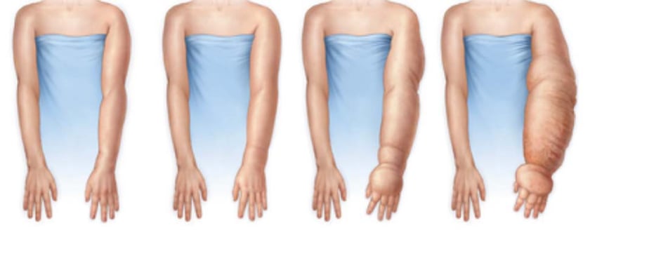 Λεμφοίδημα άνω άκρων