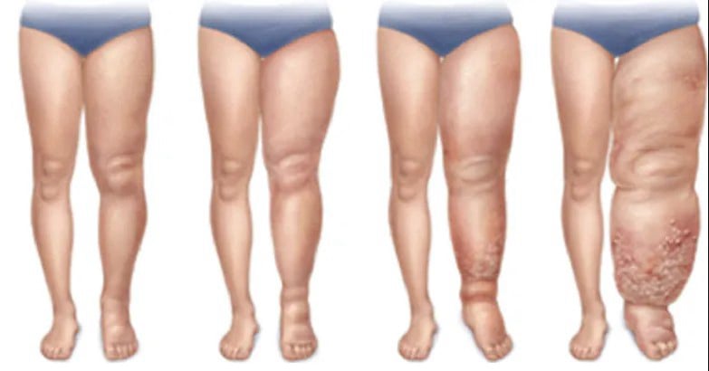 Λεμφοίδημα κάτω άκρων