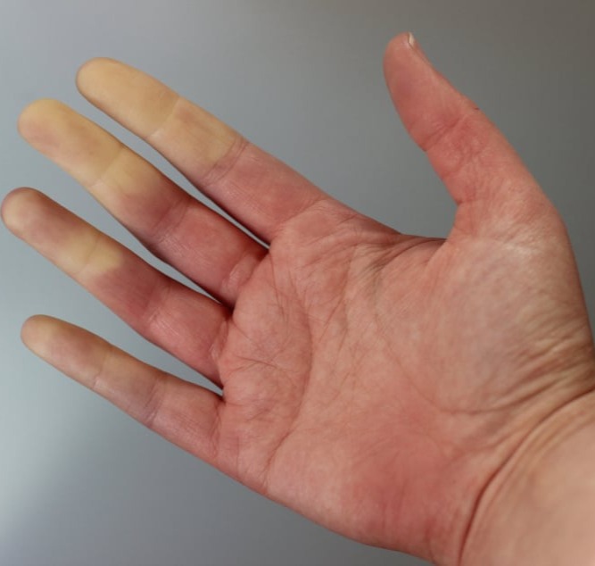 Σύνδρομο Reynaud