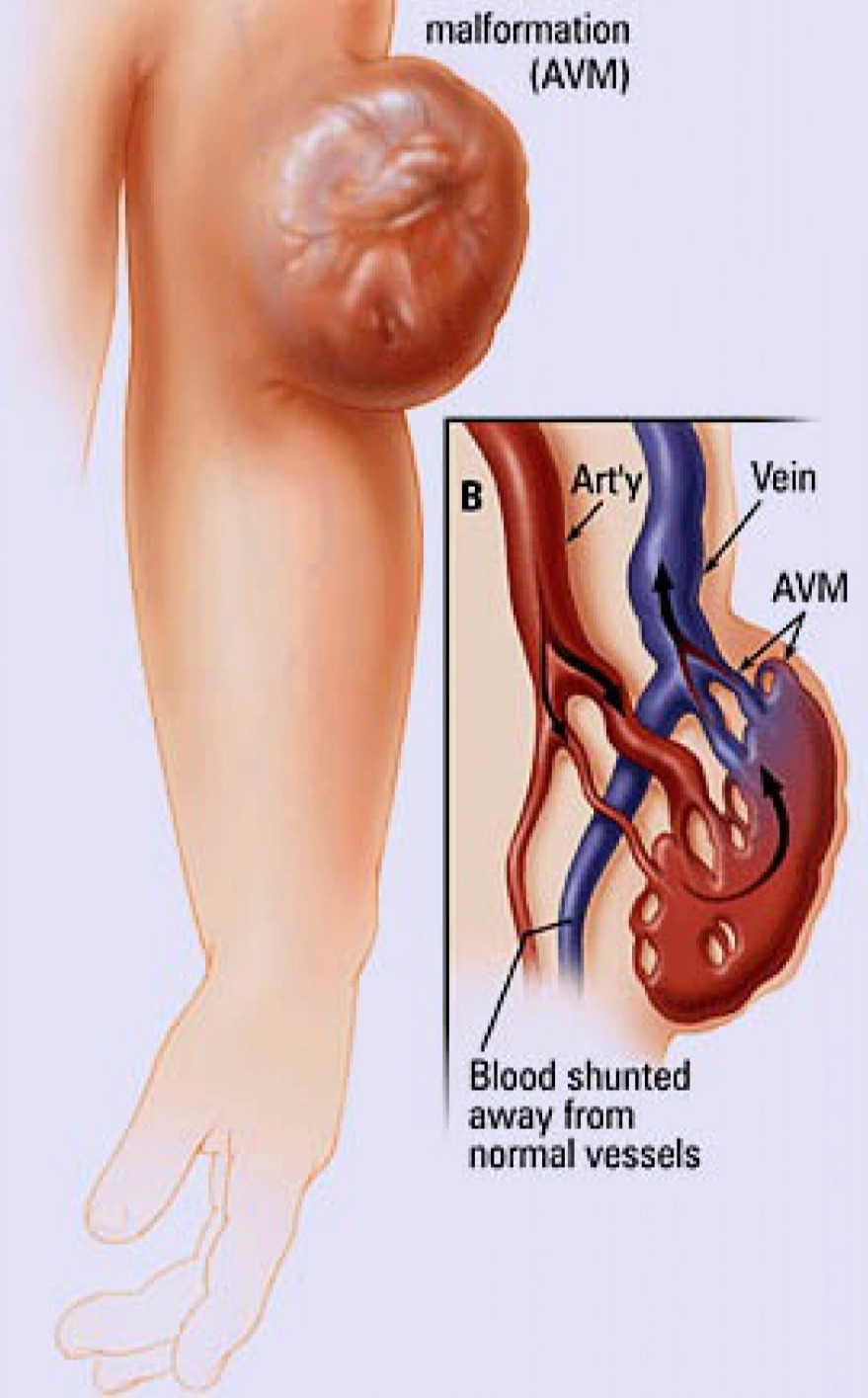 Φλεβικές Ανωμαλίες (Klippel–Trénaunay–Weber syndrome)