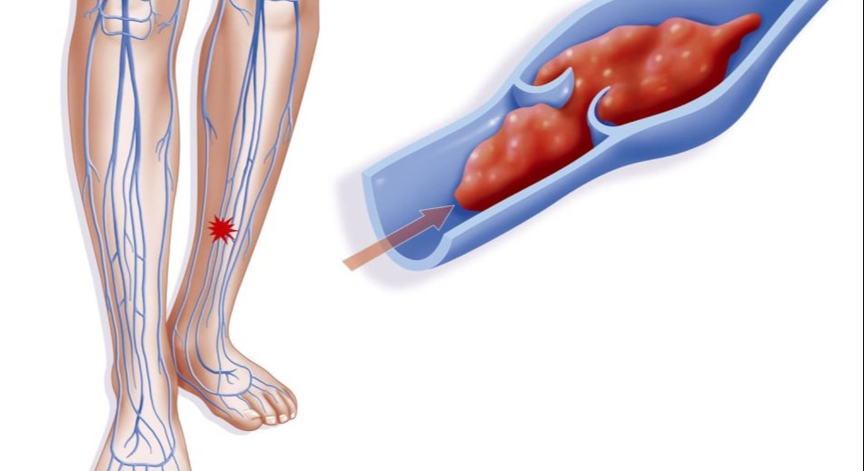 Φλεβική θρόμβωση
