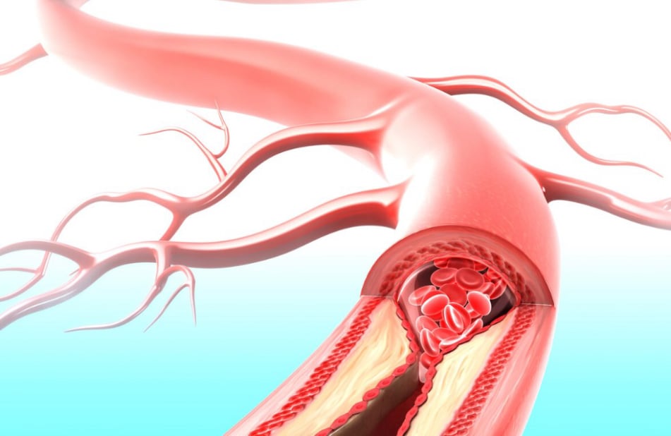 Εν τω βάθει αρτηριακές παθήσεις