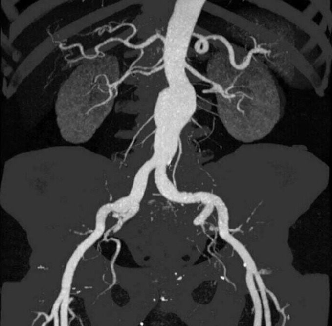 ΔΙΑΓΝΩΣΤΙΚΕΣ ΕΞΕΤΑΣΕΙΣ Κοιλιακής Αορτής και σπλαχνικών αρτηριών