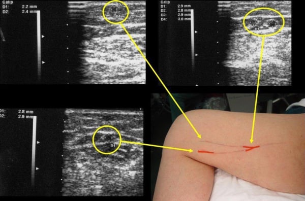 Έγχρωμο Υπερηχογράφημα Αγγείων (Colored Ultrasound Duplex Scan)