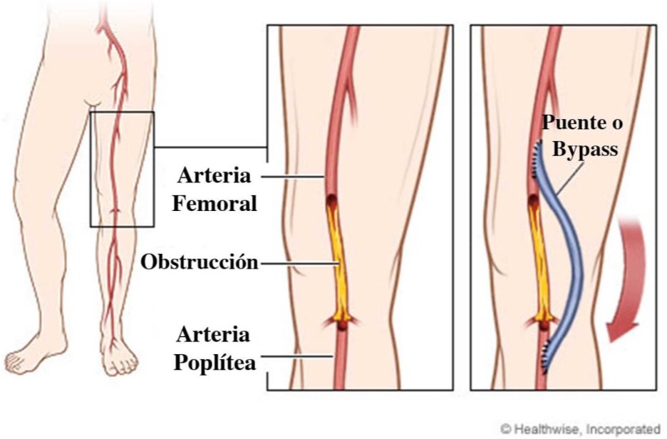 Αγγειοπλαστική λαγονίων, μηριαίων και κνημιαίων αρτηριών