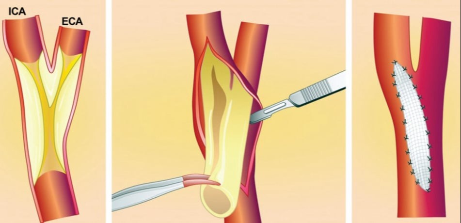 Ενδαρτηρεκτομή καρωτίδας