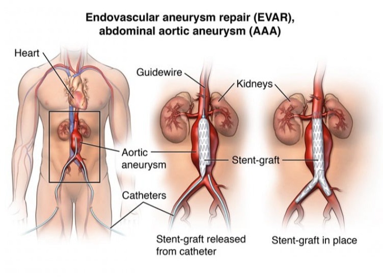 Ενδαγγειακή Αντιμετώπιση Ανευρύσματος Κοιλιακής Αορτής