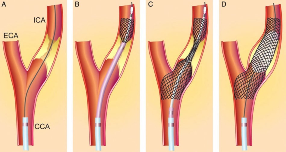 Αγγεοπλαστική και στεντ καρωτίδας (carotid stenting)